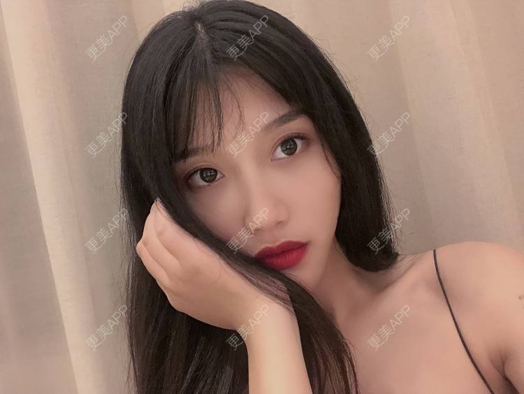 更美 - 木子木可的M唇成形经验 | M唇成形 | 杭州