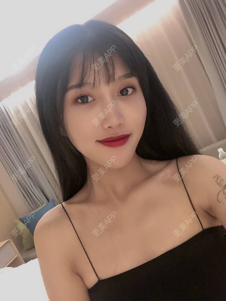 更美 - 木子木可的M唇成形经验 | M唇成形 | 杭州