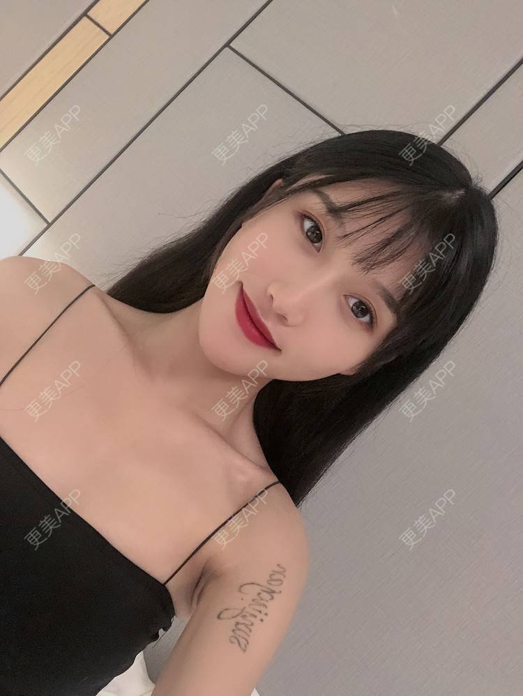 更美 - 木子木可的M唇成形经验 | M唇成形 | 杭州