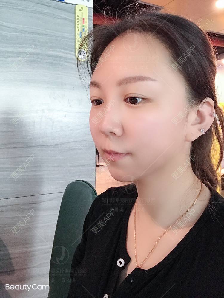 更美 - 杨宝宝😊啊的埋线提升经验 | 埋线提升 | 深圳