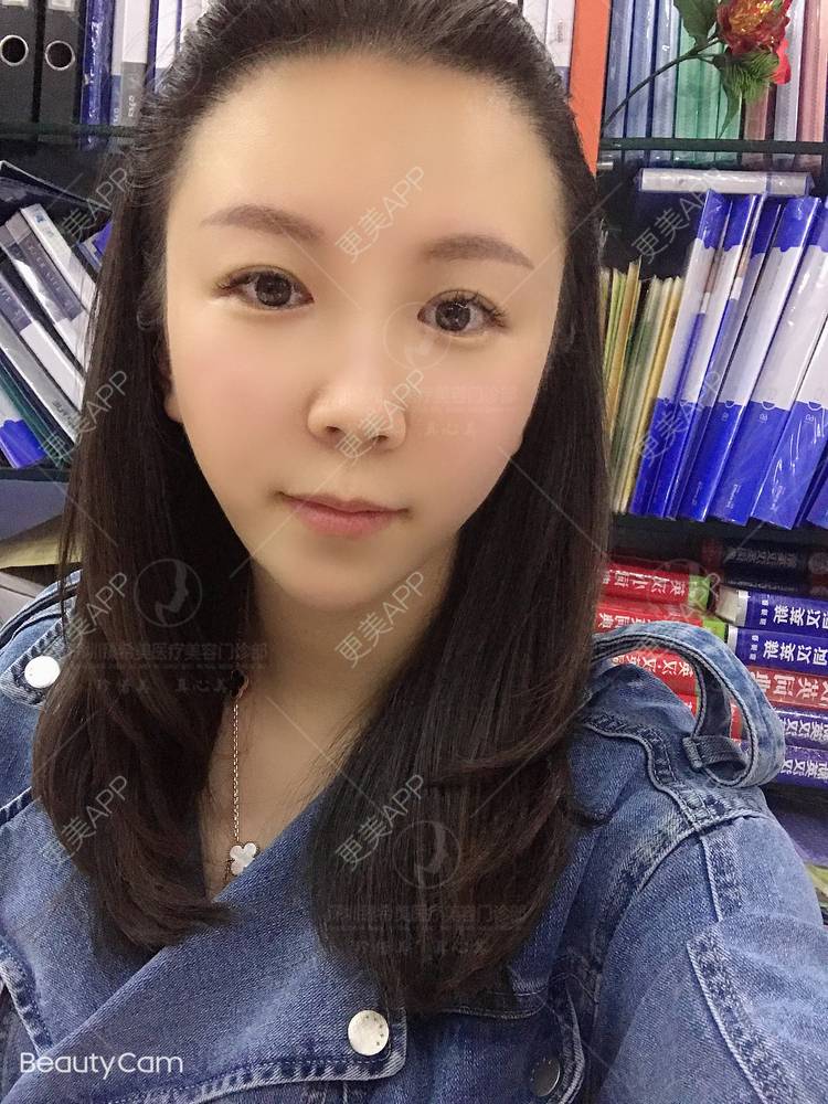 更美 - 杨宝宝😊啊的埋线提升经验 | 埋线提升 | 深圳