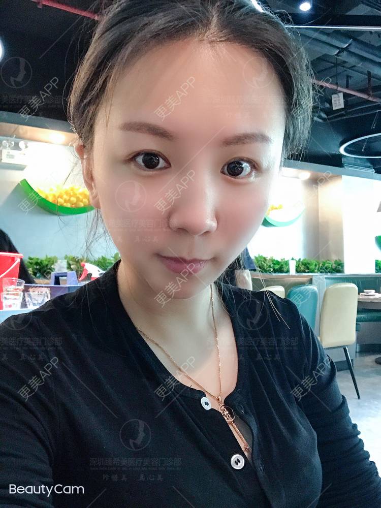 更美 - 杨宝宝😊啊的埋线提升经验 | 埋线提升 | 深圳