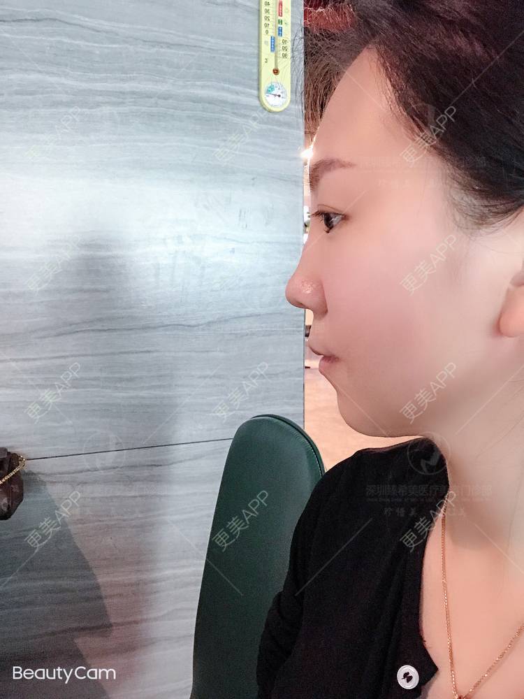 更美 - 杨宝宝😊啊的埋线提升经验 | 埋线提升 | 深圳