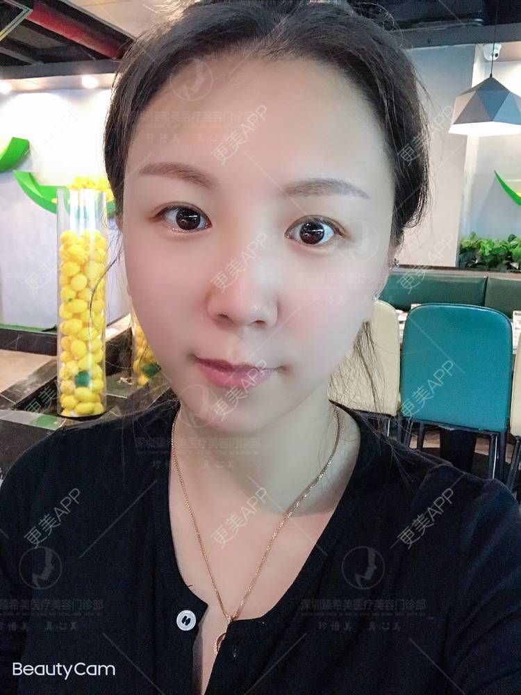 更美 - 杨宝宝😊啊的埋线提升经验 | 埋线提升 | 深圳