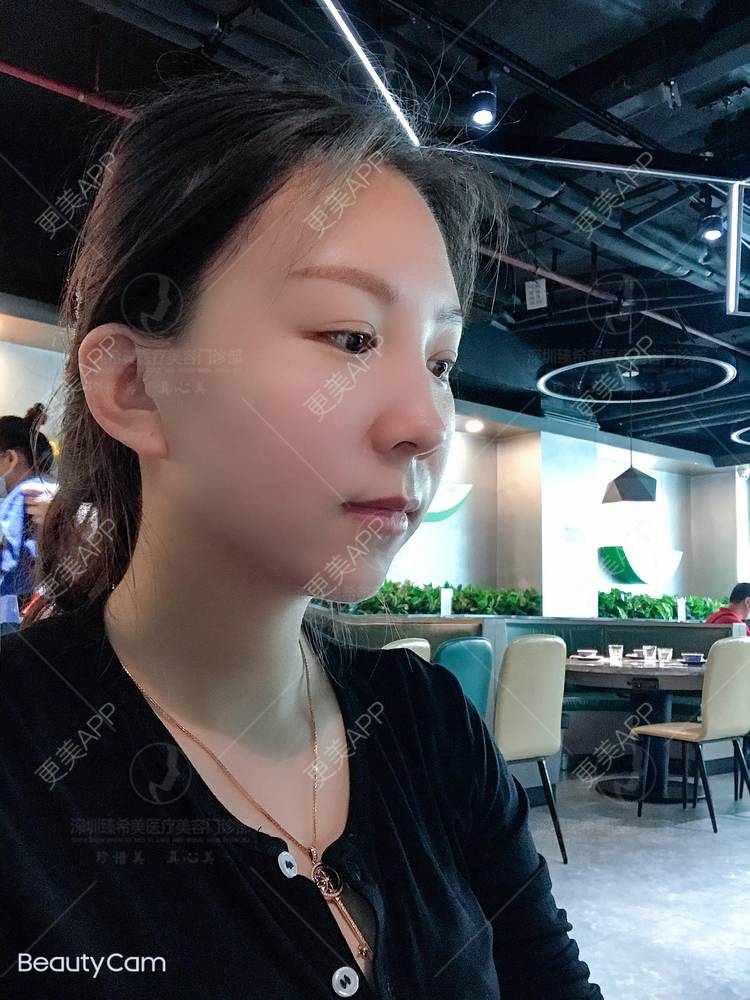 更美 - 杨宝宝😊啊的埋线提升经验 | 埋线提升 | 深圳