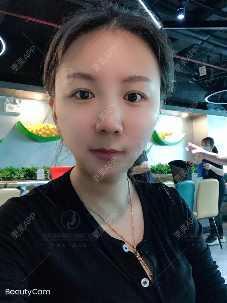 更美 - 杨宝宝😊啊的埋线提升经验 | 埋线提升 | 深圳