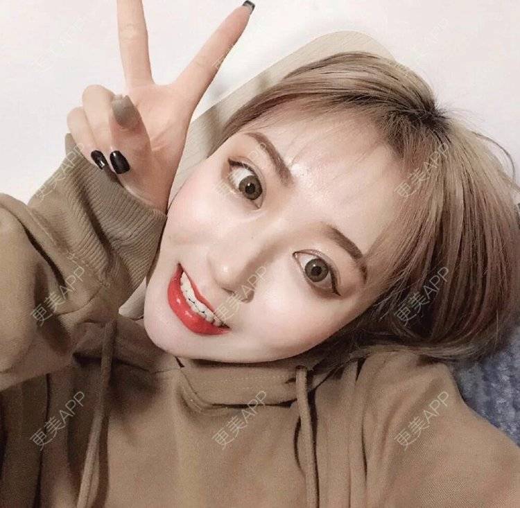 更美 - GBnm的硅胶垫下巴经验 | 硅胶垫下巴 | 南昌