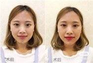 更美 - 长沙小叔叔的玻尿酸下巴经验 | 玻尿酸下巴 | 下巴截骨前移 | 自体脂肪垫下巴 | 硅胶垫下巴 | 膨体垫下巴