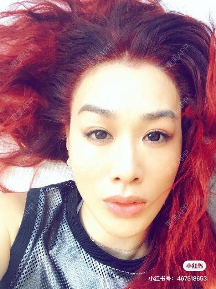 更美 - 长沙小叔叔的厚唇改薄经验 | 玻尿酸唇部 | 胶原蛋白丰唇 | 自体脂肪丰唇 | 厚唇改薄 | 长沙