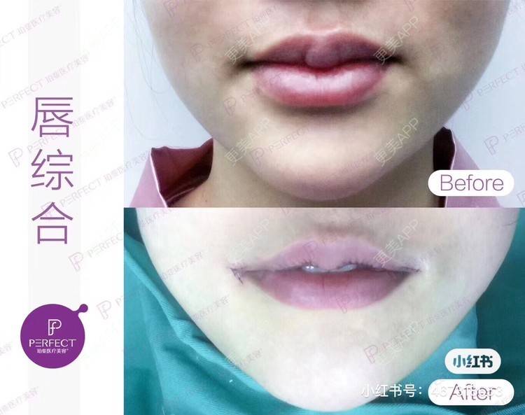 更美 - 长沙小叔叔的厚唇改薄经验 | 玻尿酸唇部 | 胶原蛋白丰唇 | 自体脂肪丰唇 | 厚唇改薄 | 长沙