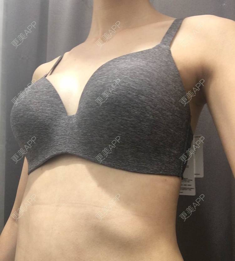 更美 - 更美用户TsqtLGm8wN的自体脂肪隆胸经验 | 自体脂肪隆胸 | 长沙