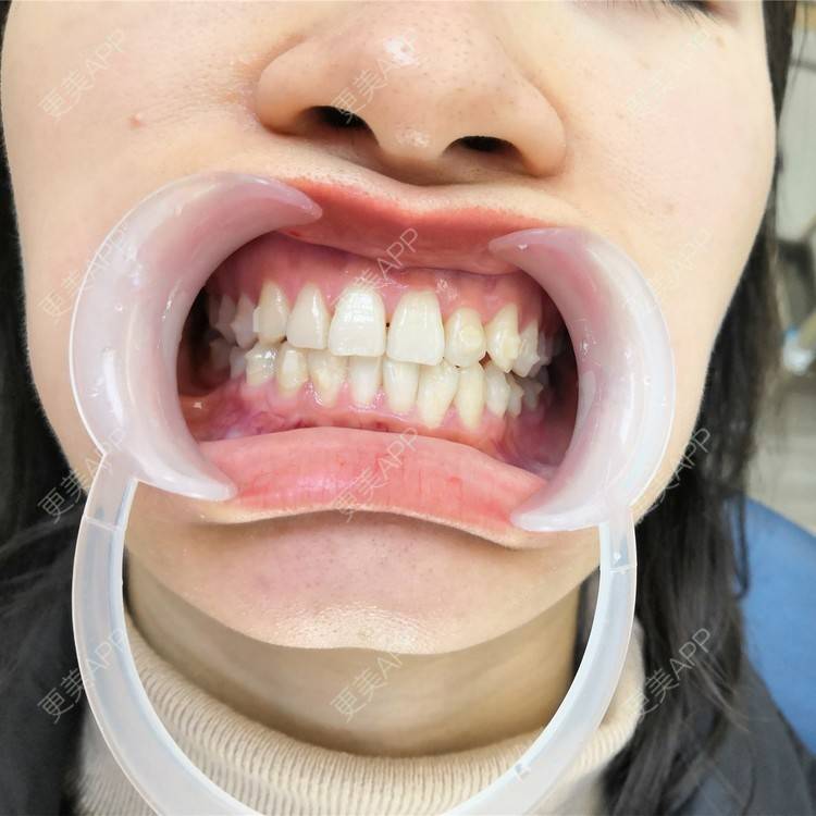 更美 - 更美用户Qb9aYmRjXc的合金烤瓷牙经验 | 合金烤瓷牙 | 合肥