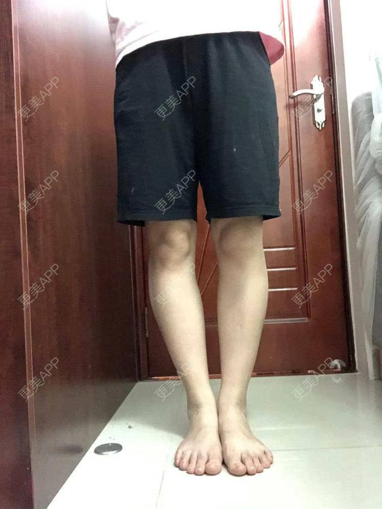 更美 - 我会用心聆听的除皱瘦脸经验 | 腿部塑形 | 除皱瘦脸 | 广州
