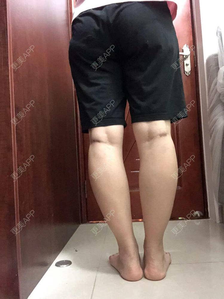 更美 - 我会用心聆听的除皱瘦脸经验 | 腿部塑形 | 除皱瘦脸 | 广州