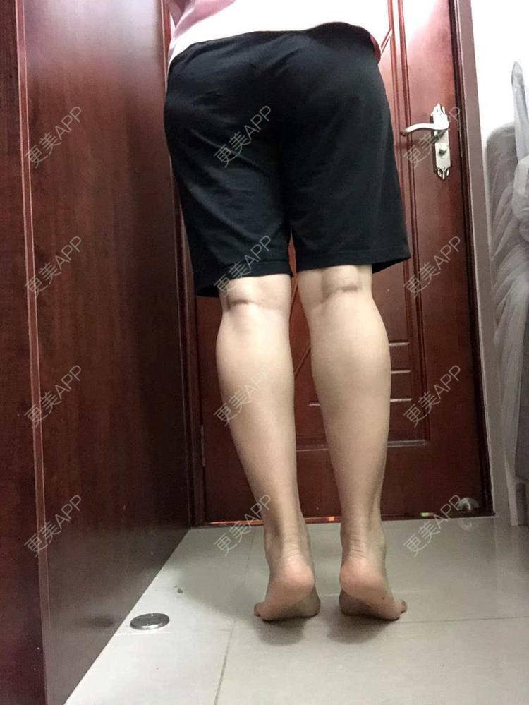更美 - 我会用心聆听的除皱瘦脸经验 | 腿部塑形 | 除皱瘦脸 | 广州
