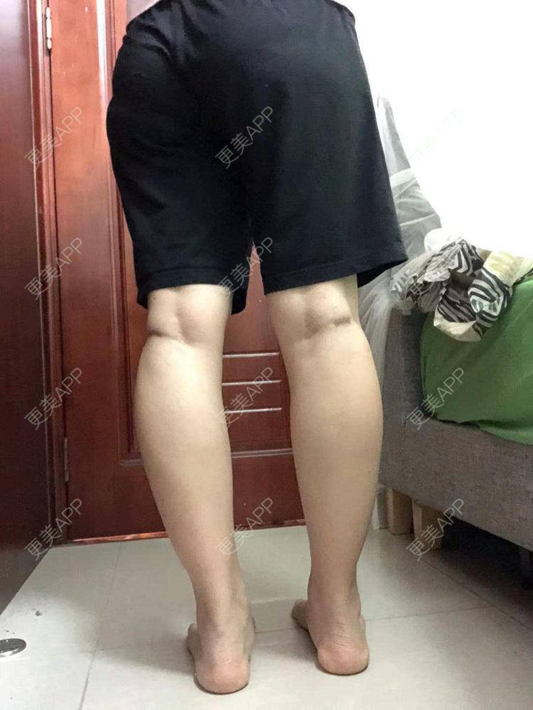更美 - 我会用心聆听的除皱瘦脸经验 | 腿部塑形 | 除皱瘦脸 | 广州