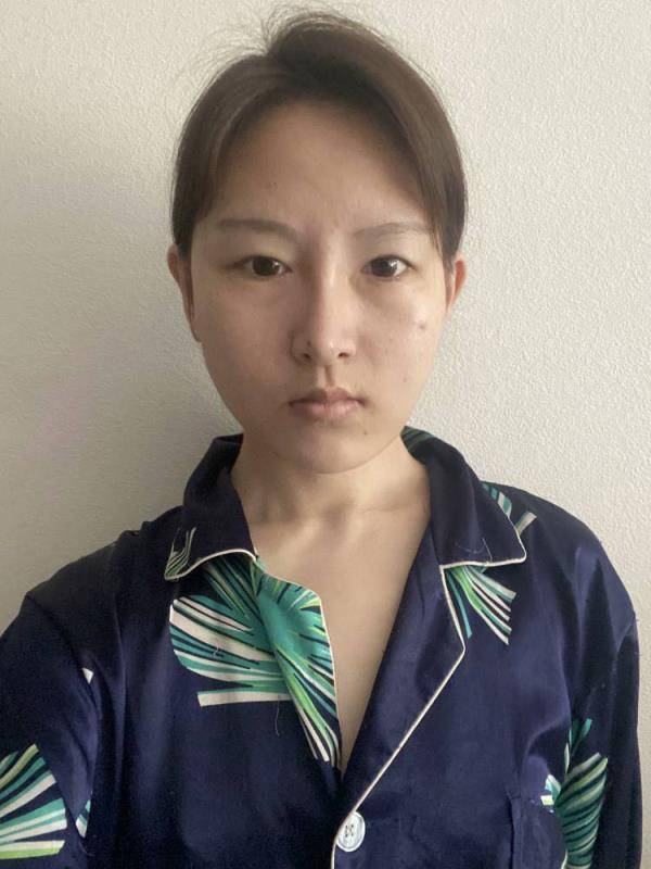 北京安贞医院整形外科王海波怎么样?眼综合案例反馈-收费标准