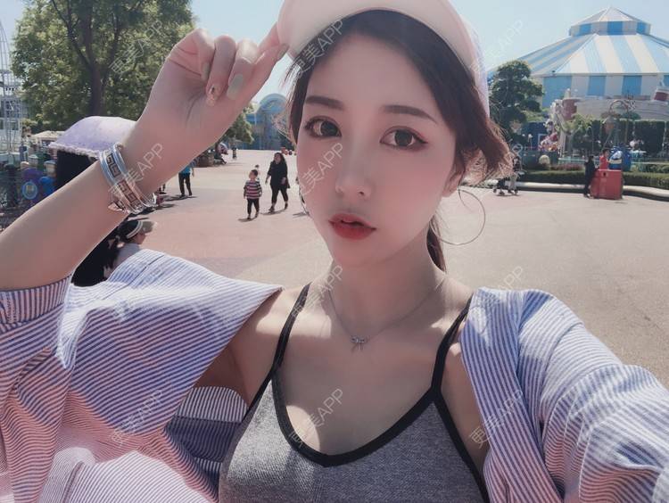 更美 - 薄情人゜缓的M唇成形经验 | M唇成形 | 武汉