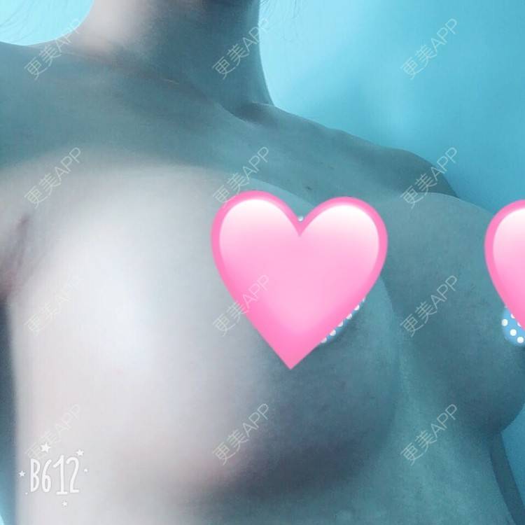 更美 - 更美用户TsqtLGm8wN的自体脂肪隆胸经验 | 自体脂肪隆胸 | 长沙