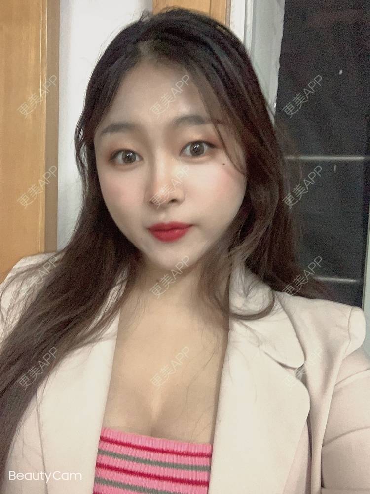 更美用户gnv8ct0xce的自体脂肪隆胸日记