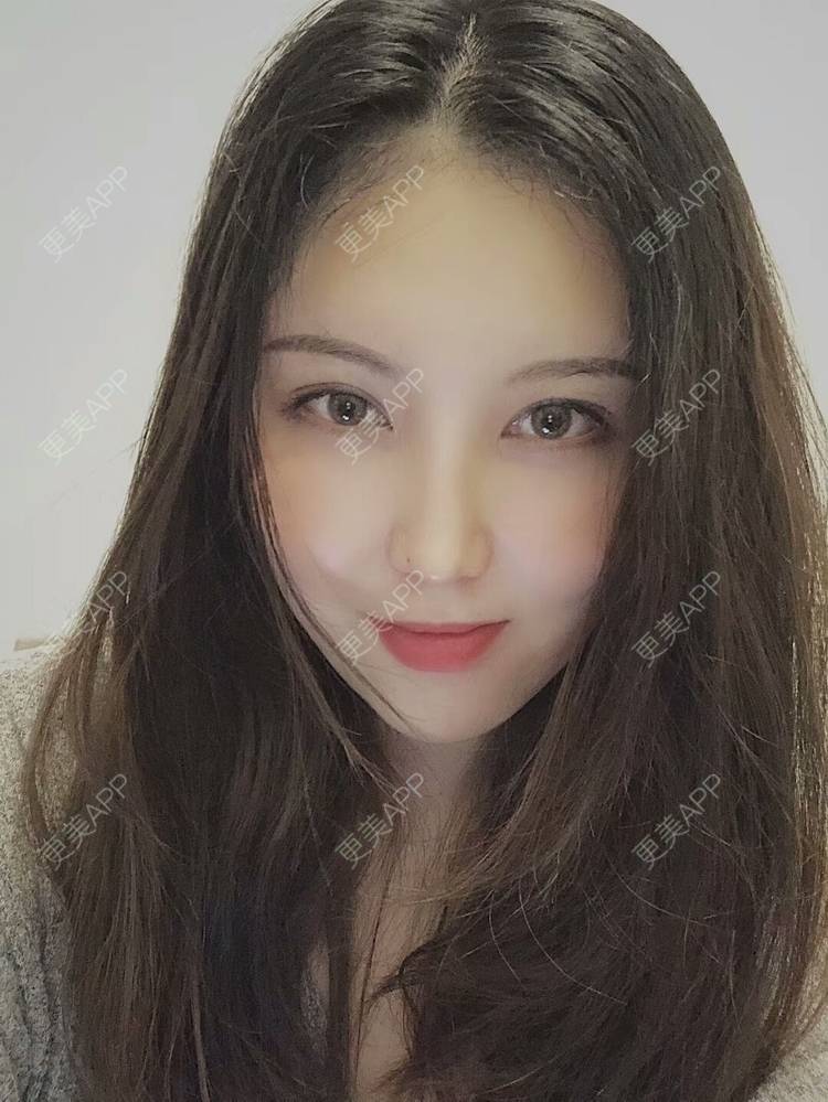 更美 - 兔子la的植发际线经验 | 视频日记 | 植眉 | 鬓角植发 | 广州 | 植发际线