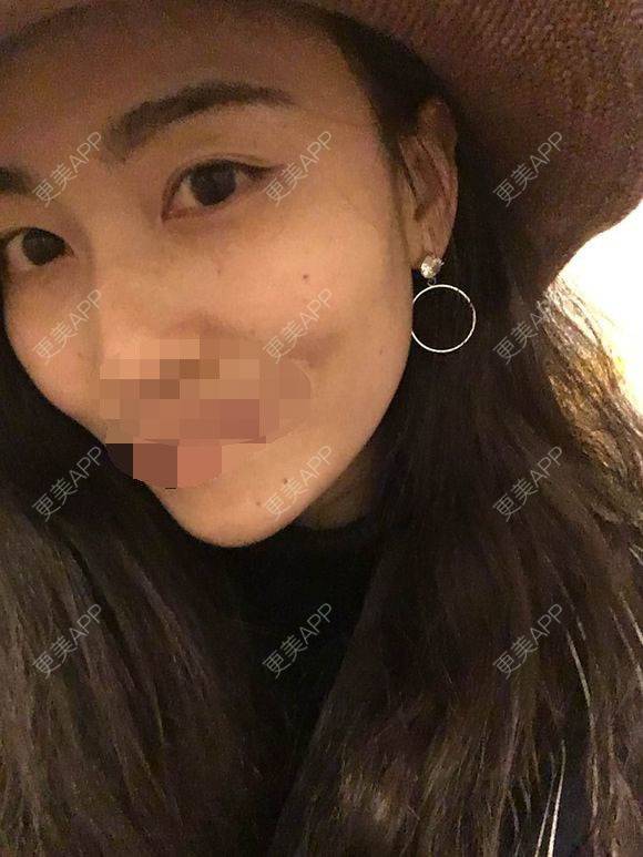 更美 - 一帘幽梦w的外切去眼袋经验 | 成都 | 外切去眼袋