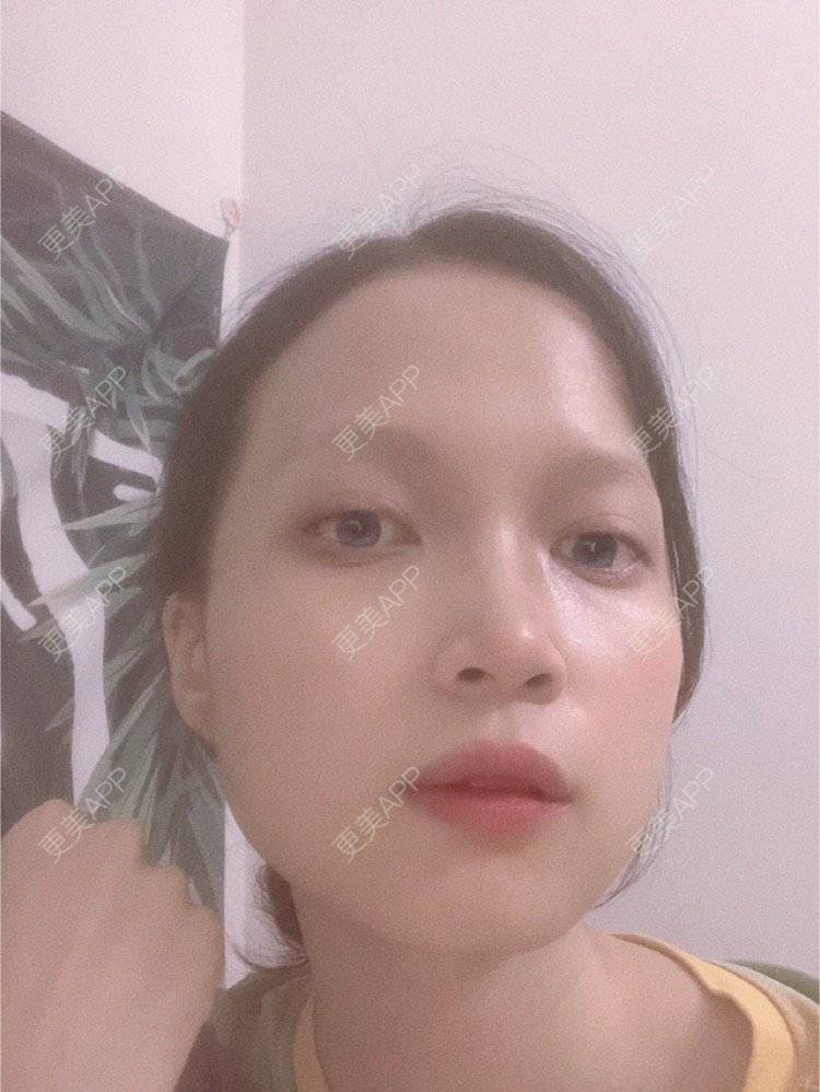 更美 - 更美用户NpS93HK67Y的双眼皮经验 | 双眼皮 | 广州