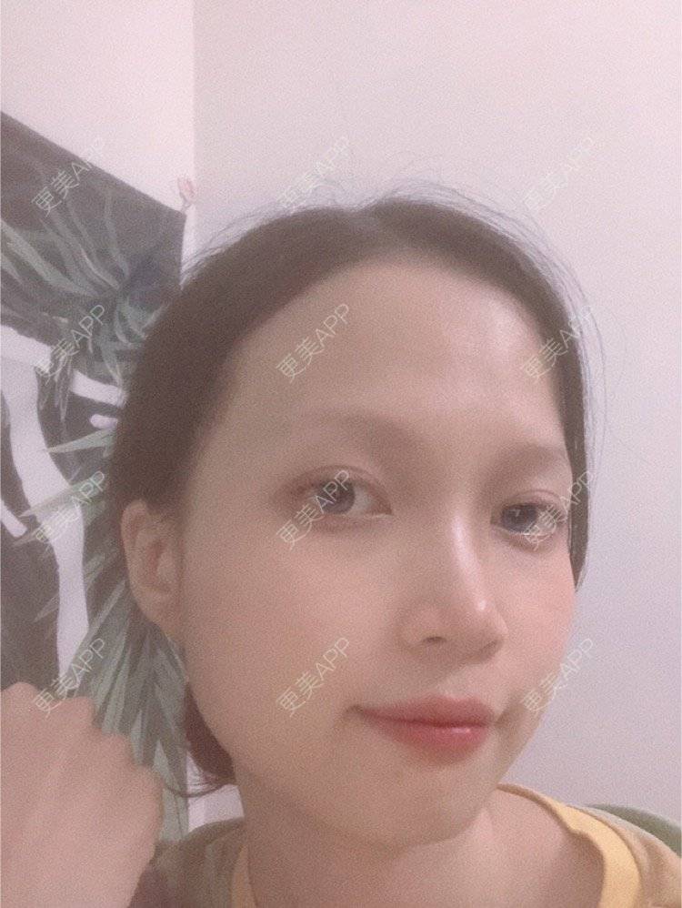 更美 - 更美用户NpS93HK67Y的双眼皮经验 | 双眼皮 | 广州