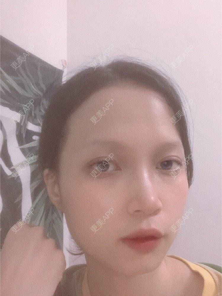 更美 - 更美用户NpS93HK67Y的双眼皮经验 | 双眼皮 | 广州