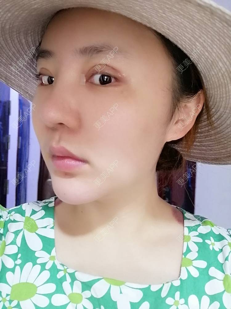 更美 - 静静子子的鼻部多项经验 | 鼻部多项 | 首尔