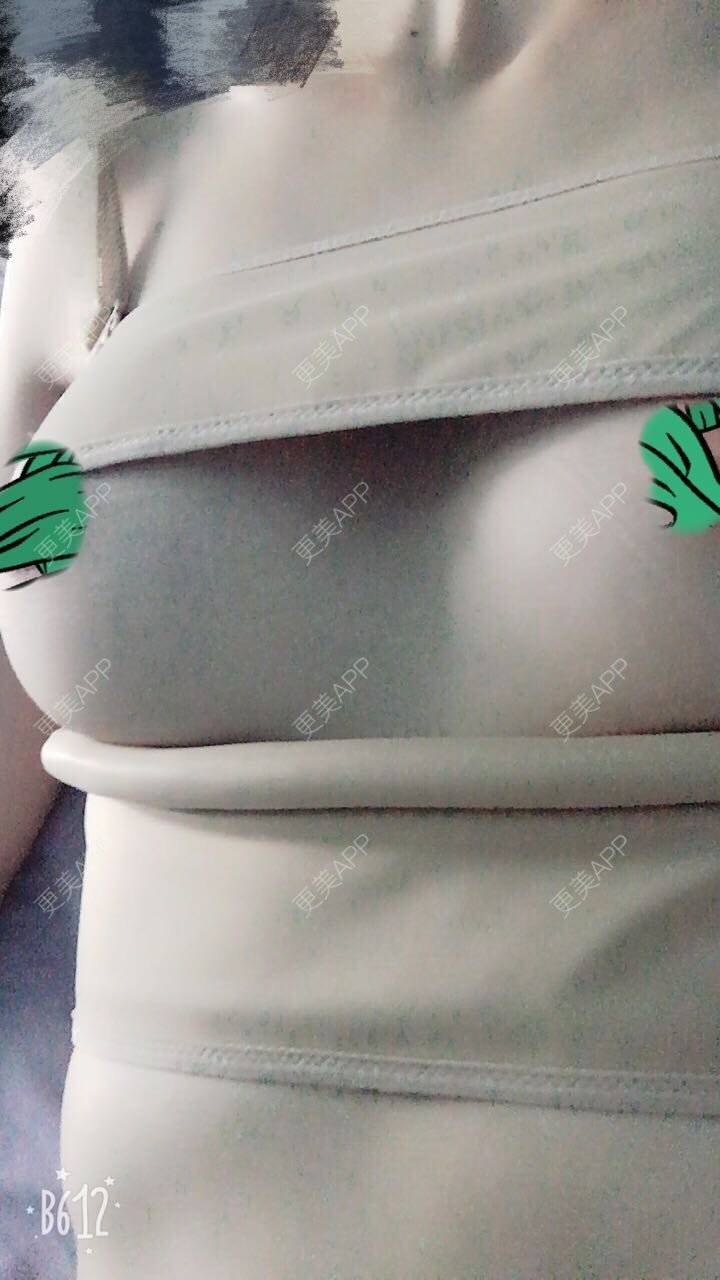 更美 - 更美用户TsqtLGm8wN的自体脂肪隆胸经验 | 自体脂肪隆胸 | 长沙
