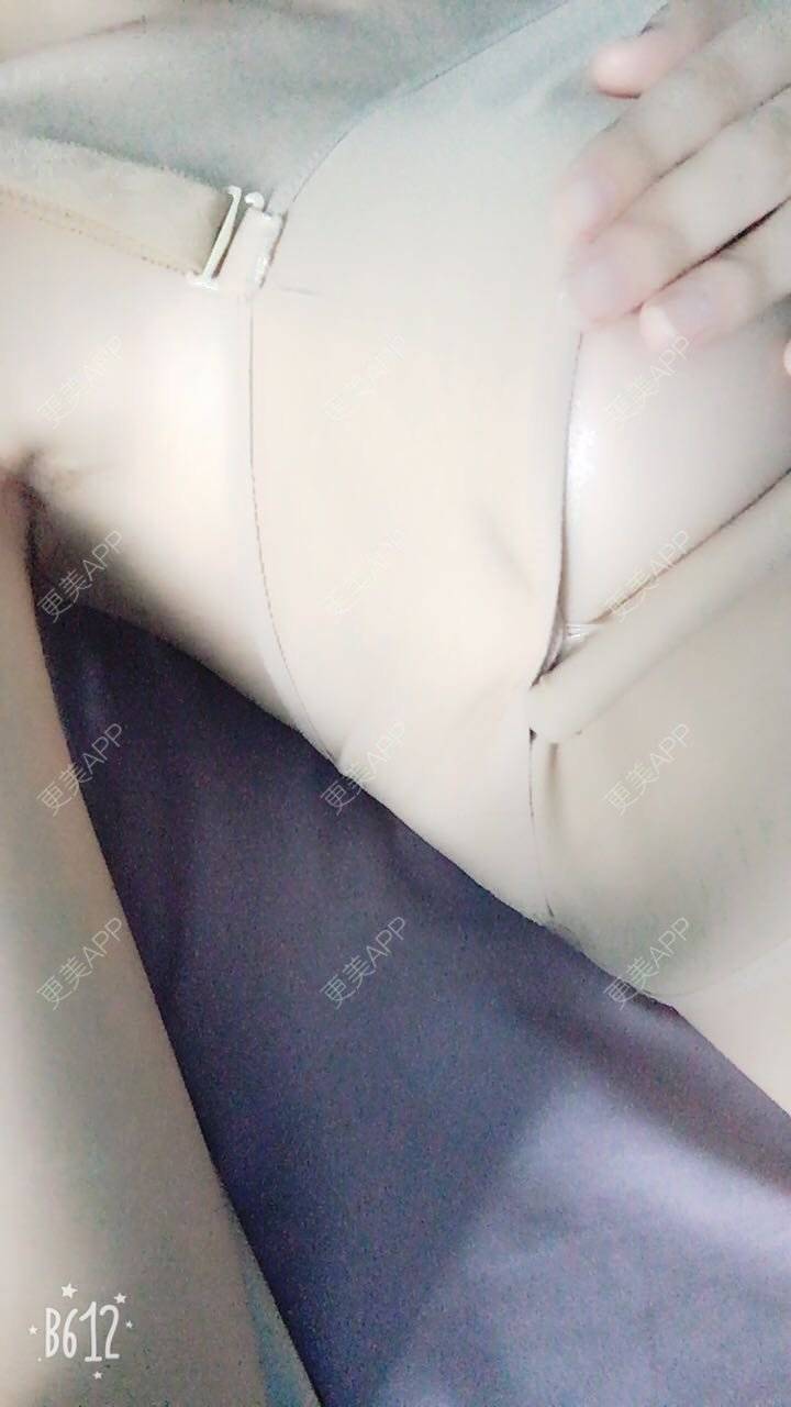 更美 - 更美用户TsqtLGm8wN的自体脂肪隆胸经验 | 自体脂肪隆胸 | 长沙
