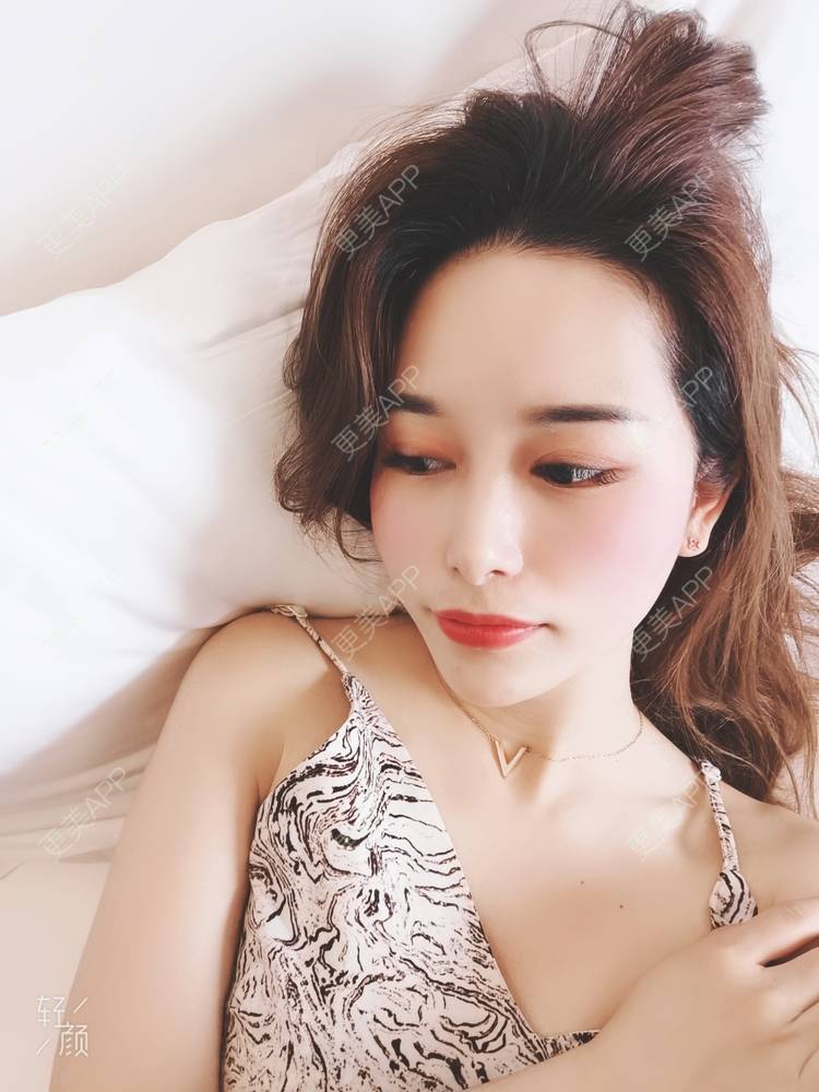 更美 - 甜心泡芙的双眼皮修复经验 | 双眼皮 | 全切双眼皮 | 开内眼角 | 重庆 | 双眼皮修复