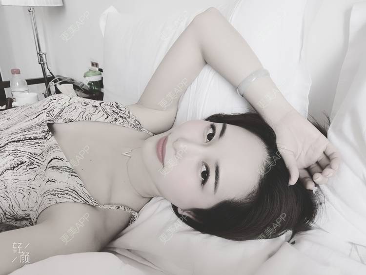 更美 - 甜心泡芙的双眼皮修复经验 | 双眼皮 | 全切双眼皮 | 开内眼角 | 重庆 | 双眼皮修复