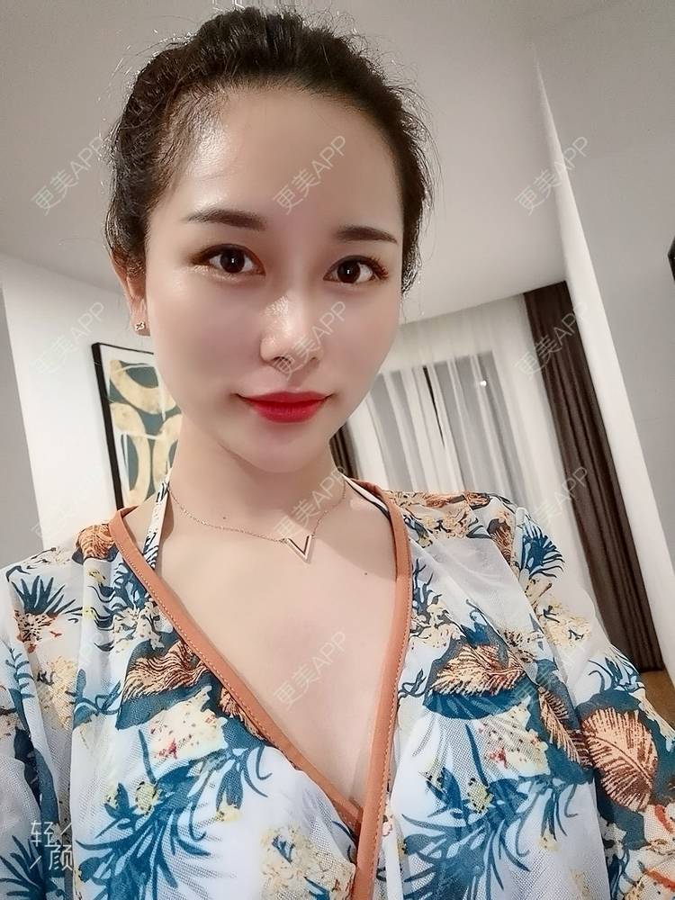 更美 - 甜心泡芙的双眼皮修复经验 | 双眼皮 | 全切双眼皮 | 开内眼角 | 重庆 | 双眼皮修复