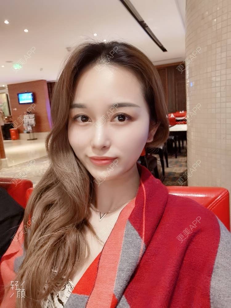 更美 - 甜心泡芙的双眼皮修复经验 | 双眼皮 | 全切双眼皮 | 开内眼角 | 重庆 | 双眼皮修复