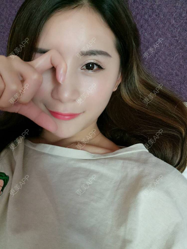 更美 - Imiss you的宽下巴矫正经验 | 自体脂肪垫下巴 | 硅胶垫下巴 | 膨体垫下巴 | 玻尿酸下巴 | 下巴截骨前移 | 宽下巴矫正 | 自体脂肪丰太阳穴 | 硅胶丰太阳穴 | 膨体丰太阳穴 | 成都 | 人工骨垫下巴