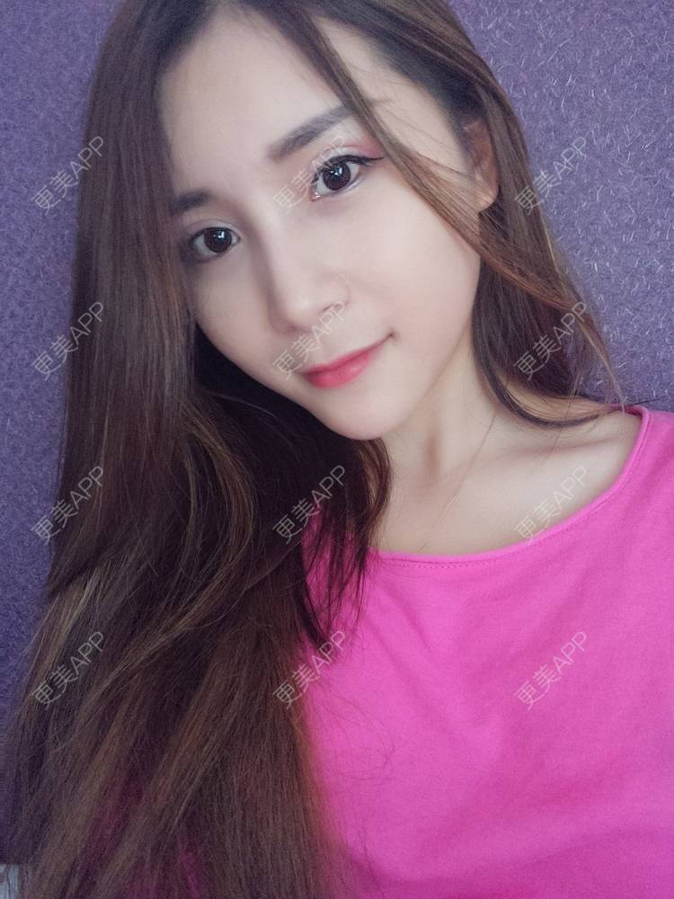 更美 - Imiss you的宽下巴矫正经验 | 自体脂肪垫下巴 | 硅胶垫下巴 | 膨体垫下巴 | 玻尿酸下巴 | 下巴截骨前移 | 宽下巴矫正 | 自体脂肪丰太阳穴 | 硅胶丰太阳穴 | 膨体丰太阳穴 | 成都 | 人工骨垫下巴