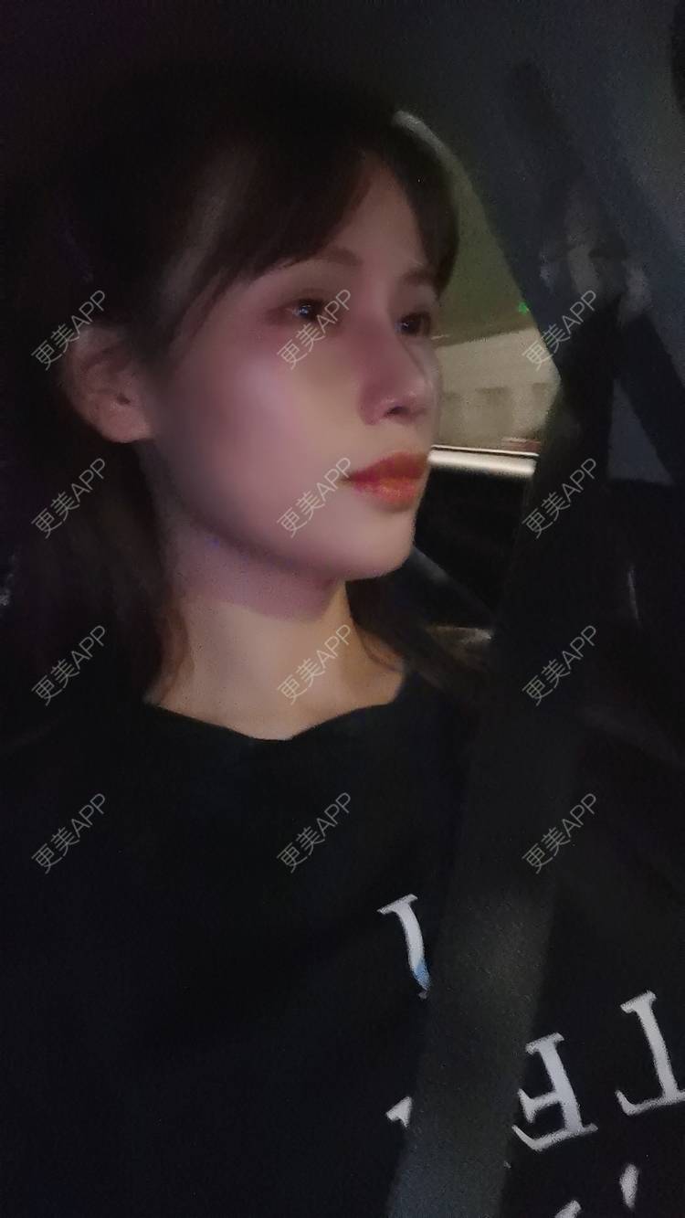 更美 - Sarah龙锦er🇨🇳的吸脂瘦脸经验 | 吸脂瘦脸 | 武汉