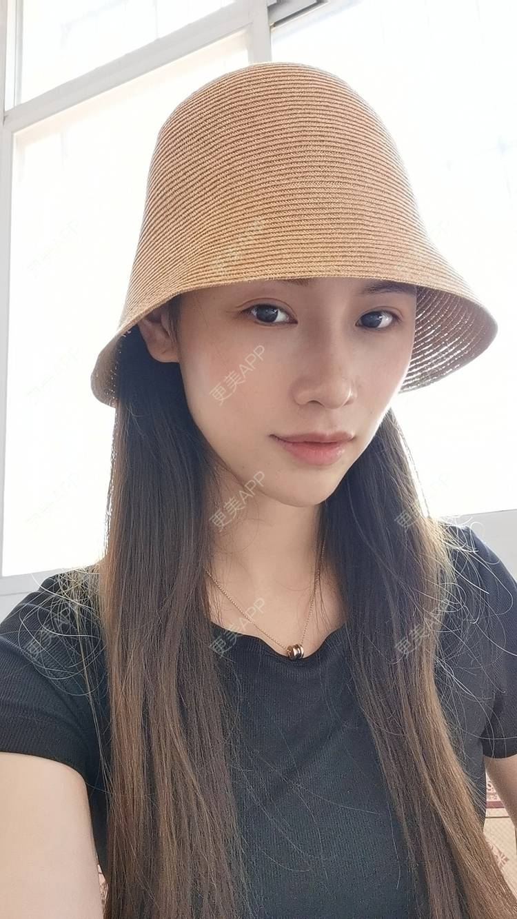 更美 - Sarah龙锦er🇨🇳的吸脂瘦脸经验 | 吸脂瘦脸 | 武汉