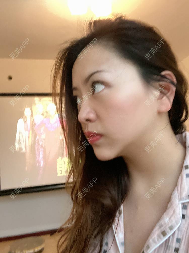 更美 - 夹心巧克力的膨体垫下巴经验 | 下巴 | 玻尿酸下巴 | 下巴截骨前移 | 自体脂肪垫下巴 | 硅胶垫下巴 | 膨体垫下巴 | 缩下巴 | 胶原蛋白丰下巴 | 人工骨垫下巴