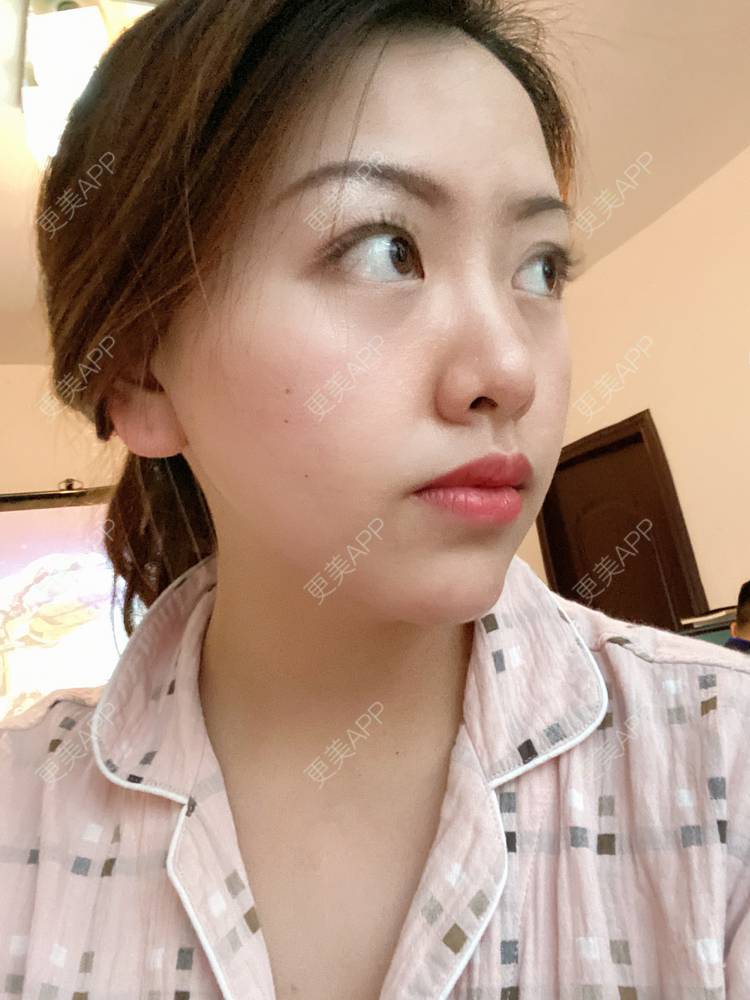 更美 - 夹心巧克力的膨体垫下巴经验 | 下巴 | 玻尿酸下巴 | 下巴截骨前移 | 自体脂肪垫下巴 | 硅胶垫下巴 | 膨体垫下巴 | 缩下巴 | 胶原蛋白丰下巴 | 人工骨垫下巴
