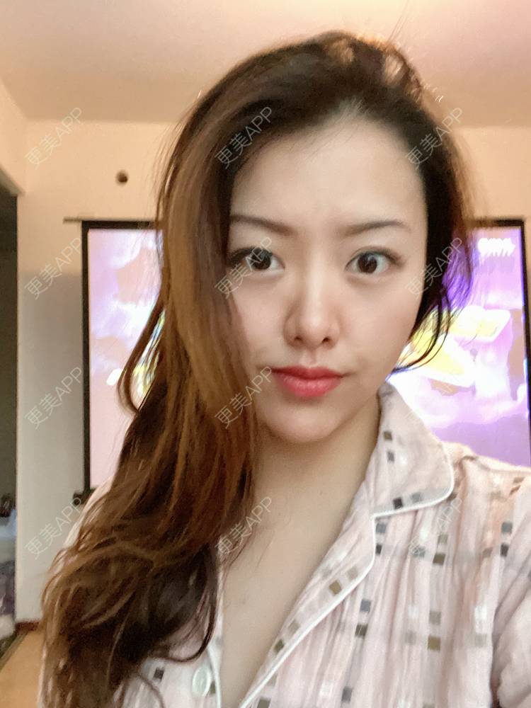更美 - 夹心巧克力的膨体垫下巴经验 | 下巴 | 玻尿酸下巴 | 下巴截骨前移 | 自体脂肪垫下巴 | 硅胶垫下巴 | 膨体垫下巴 | 缩下巴 | 胶原蛋白丰下巴 | 人工骨垫下巴