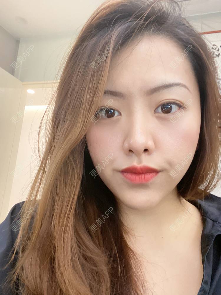 更美 - 夹心巧克力的膨体垫下巴经验 | 下巴 | 玻尿酸下巴 | 下巴截骨前移 | 自体脂肪垫下巴 | 硅胶垫下巴 | 膨体垫下巴 | 缩下巴 | 胶原蛋白丰下巴 | 人工骨垫下巴