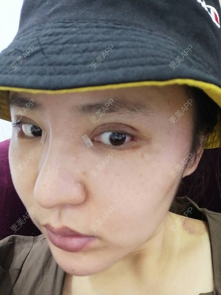 更美 - 静静子子的鼻部多项经验 | 鼻部多项 | 首尔