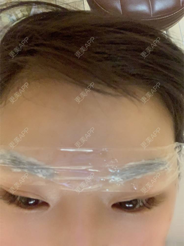 更美 - 虽醉尤醒的激光洗眉经验 | 上海 | 激光洗眉
