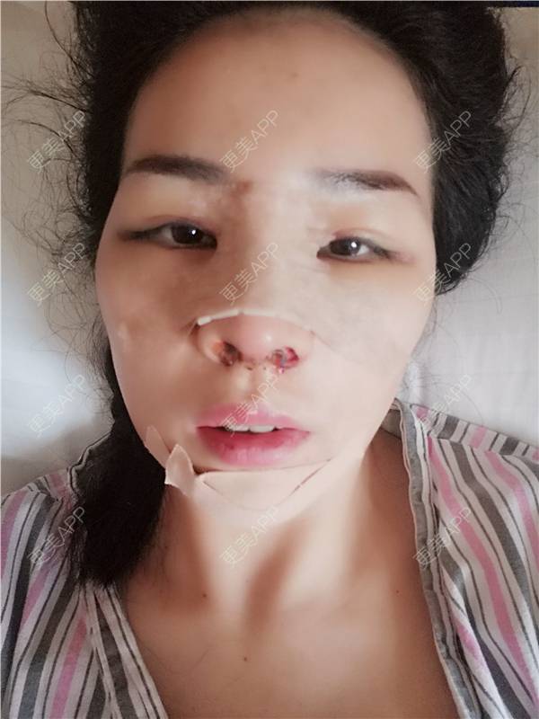 更美 - 更美用户XFxqGjA00s的硅胶垫下巴经验 | 缩下巴 | 硅胶垫下巴 | 下巴