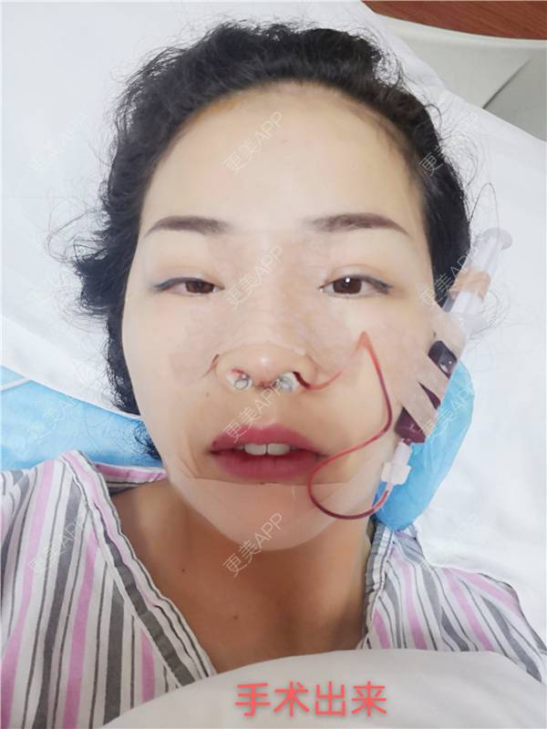 更美 - 更美用户XFxqGjA00s的硅胶垫下巴经验 | 缩下巴 | 硅胶垫下巴 | 下巴