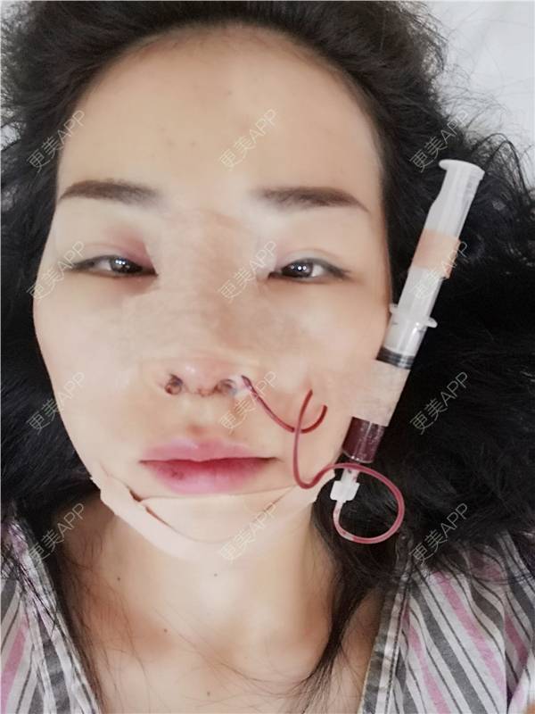 更美 - 更美用户XFxqGjA00s的硅胶垫下巴经验 | 缩下巴 | 硅胶垫下巴 | 下巴