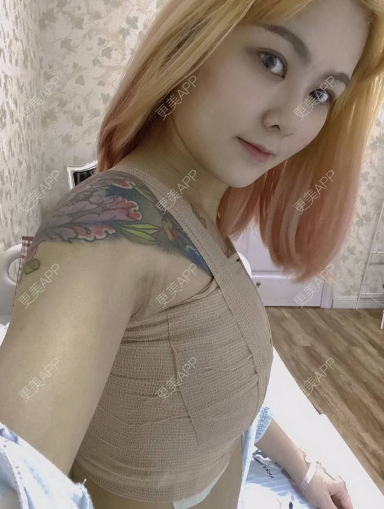 更美 - 珊小姐的自体脂肪隆胸经验 | 自体脂肪隆胸 | 南昌